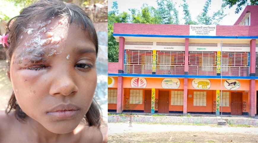 শিক্ষার্থীদের চাঁদায় শিক্ষক দিবস, পার্টি স্প্রেতে ছাত্রীর চোখ ক্ষতিগ্রস্ত