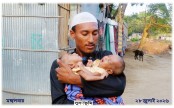 অর্থাভাবে থমকে আছে জোড়া লাগা যমজ শিশুর চিকিৎসা: সহায়তার আবেদন